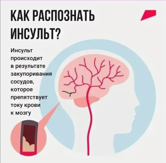 Как распознать инсульт?.